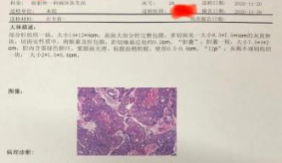 肝癌合并门静脉癌栓行转化降期后根治性切除术