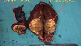 肝癌术后复发合并右肺孤立转移灶行腹腔镜、胸腔镜联合手