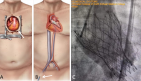 图1. 经导管主动脉瓣置换术（TAVR），A.常规开胸换瓣手术，B.TAVR手术，C.TAVR换瓣成功，箭头示手术切口