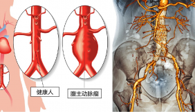 图6. 腹主动脉瘤的微创腔内支架隔绝术