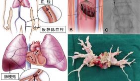 图8. 急慢性肺动脉栓塞治疗。A.肺栓塞机制图，B.下腔静脉滤器预防肺栓塞模拟图，C.下腔静脉滤器植入图，D.慢性肺栓塞机化血栓取出图